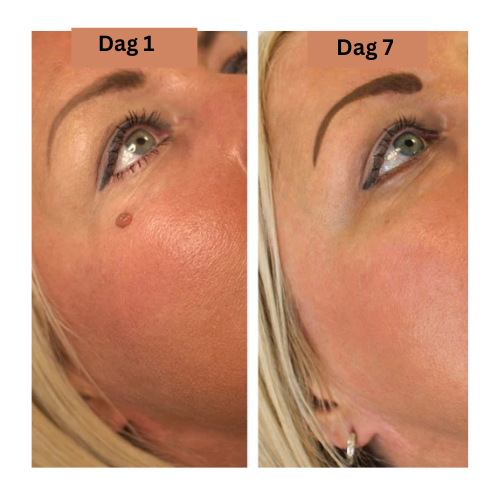 SkinEase - Små förändringar, Stor känsla